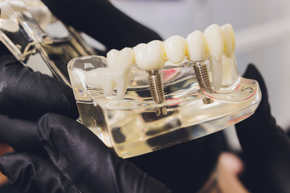 Implantes